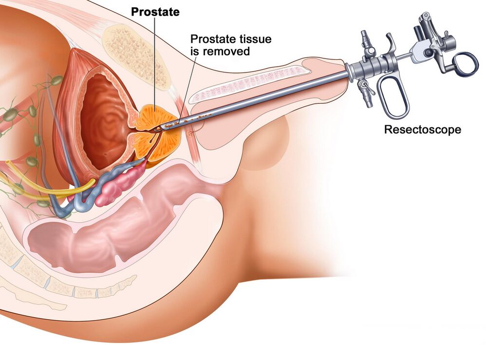 Prostatas audu savākšana precīzai prostatīta diagnostikai