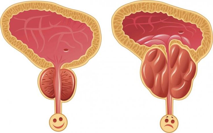 Veselīgs prostatas un prostatīts