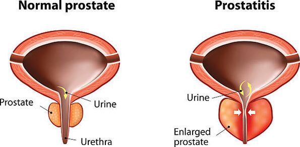 normāla un iekaisusi prostata